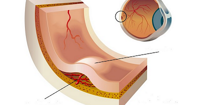 Діабетичний макулярний набряк: сучасні методи лікування та профілактики