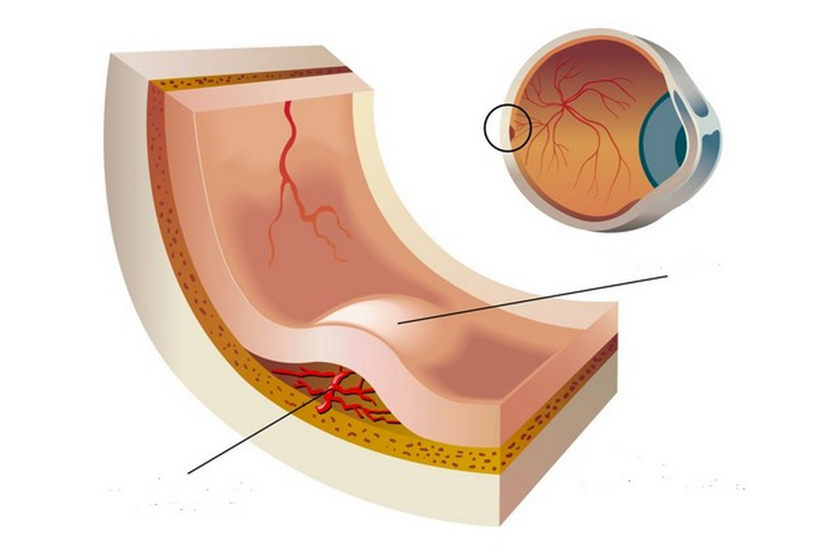 Діабетичний макулярний набряк: сучасні методи лікування та профілактики